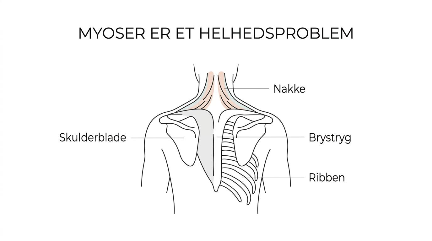 Illustration af nakke, skuldre, skulderblade, brystryg og ribben med markerede spændingsområder og udstrålende smerte.